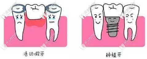 活動(dòng)假牙與種植牙的區(qū)別