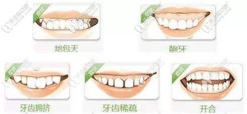 哪些人適合做隱形矯正？