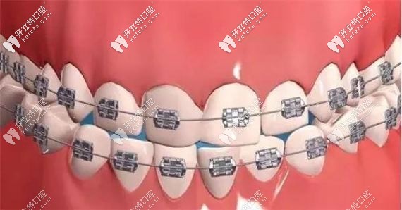 自鎖托槽矯正圖