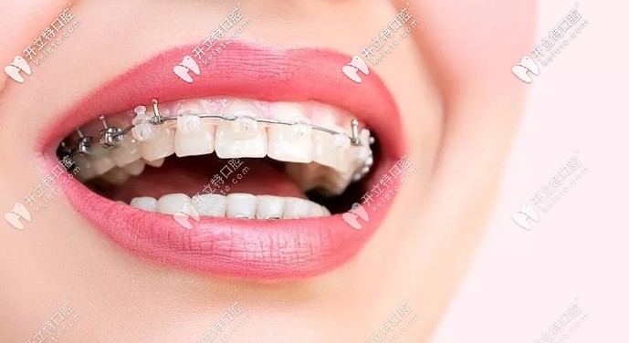 陶瓷半隱形矯正圖