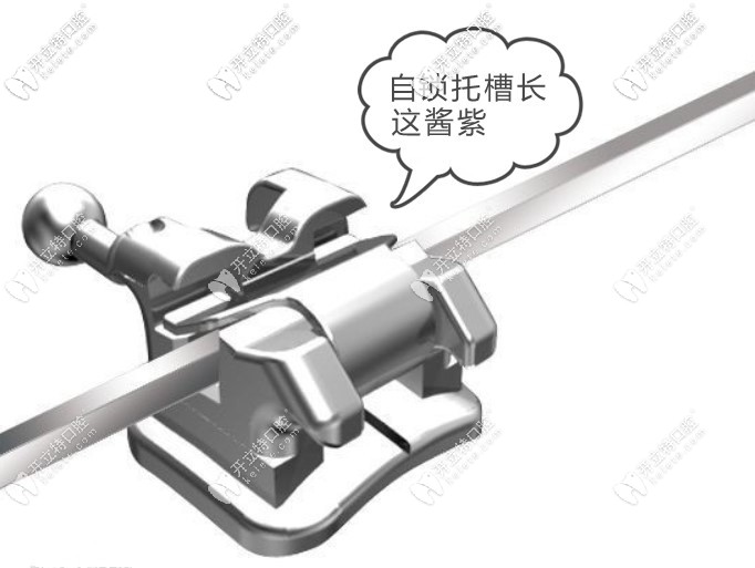 自鎖托槽矯正一萬貴嗎