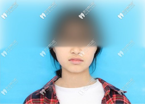 拔4顆牙臉型圖，我覺得自己臉沒塌