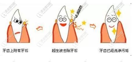 定期洗牙預(yù)防牙周病