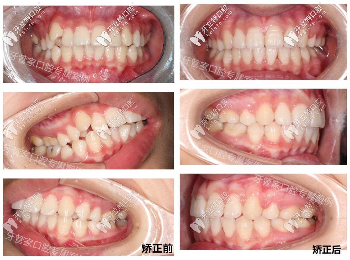 骨性齙牙戴牙套矯正前后效果對比圖