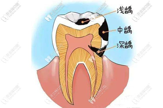 崔巧明醫(yī)生提醒大家補(bǔ)牙宜早不宜遲