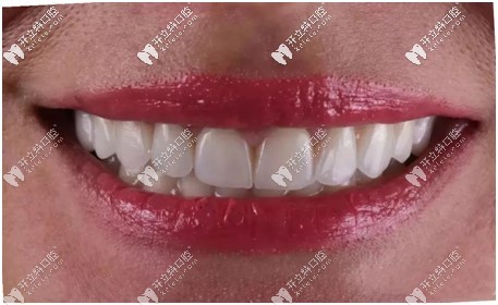 e-max貼面口腔效果圖 e-max貼面口腔效果圖