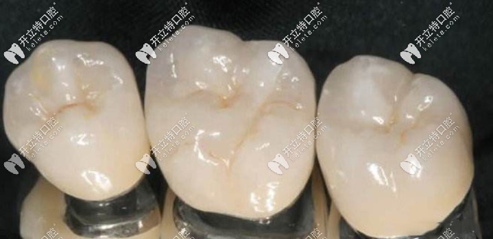 后牙金屬烤瓷牙 后牙金屬烤瓷牙