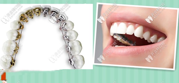 關于舌側矯正的價格貴于唇側矯正的原因