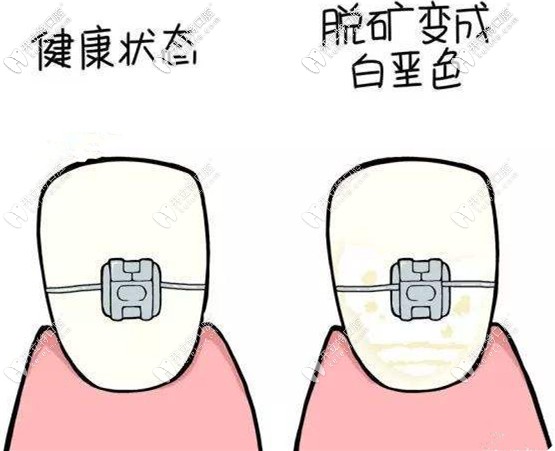 帶完金屬托槽可能會導(dǎo)致脫礦 帶完金屬托槽可能會導(dǎo)致脫礦