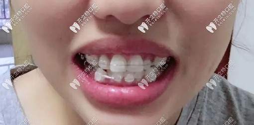 戴陶瓷自鎖托槽中期，牙齒已經(jīng)開始慢慢歸位