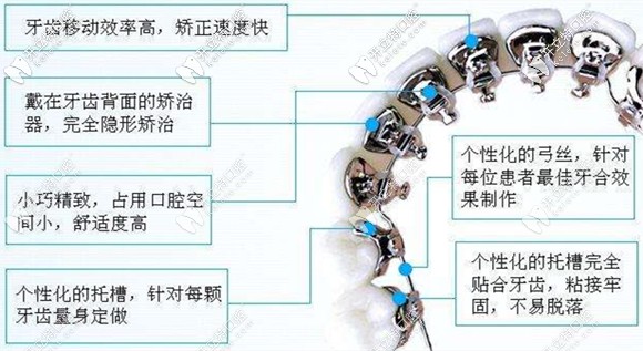關于舌側隱形矯正的優(yōu)點