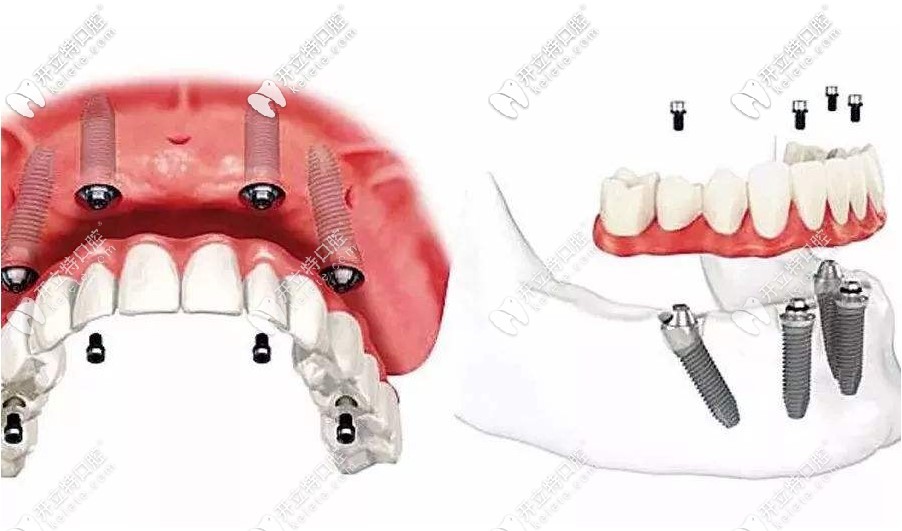 徐州美奧牙科進(jìn)口種植牙