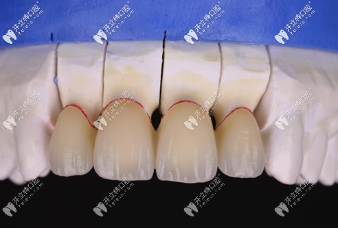 長沙利爾澤康全瓷冠