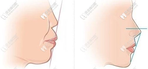 齙牙的嘴型和正常的嘴型對(duì)比圖