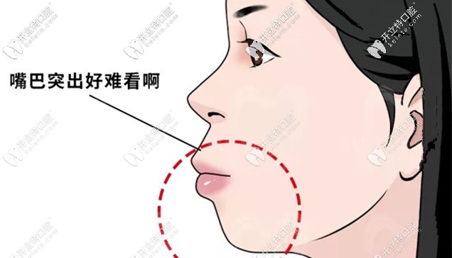 矯正后嘴巴突出好難看啊