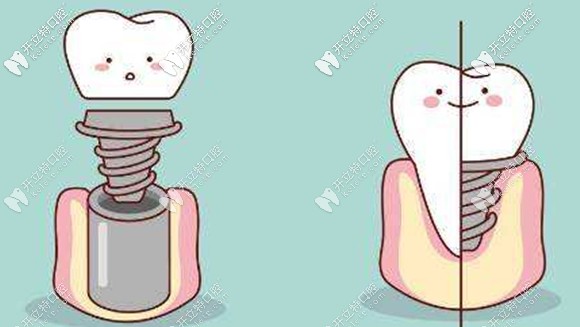 種植牙維護(hù)常識(shí)