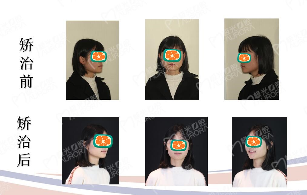 成都極光口腔誰說25歲矯正牙齒沒必要,在成都門牙地包天矯正后也很漂亮