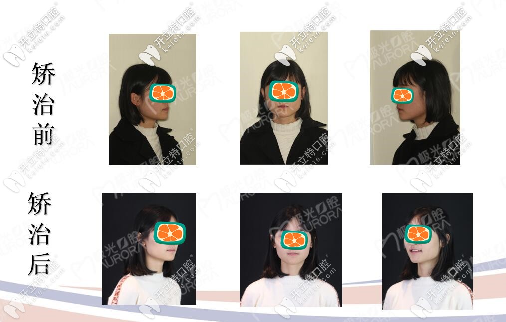 地包天矯正前后對(duì)比圖