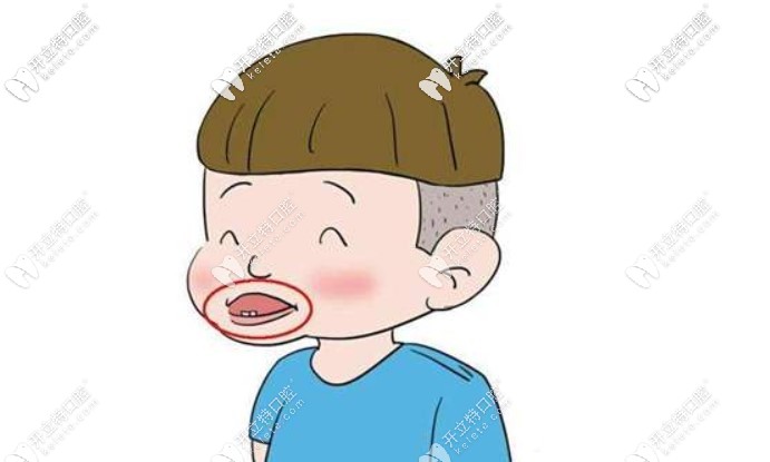  嫌羅慕矯治器與mrc麻煩，簡(jiǎn)便的嘟嘟嘴訓(xùn)練器你可不能錯(cuò)過(guò)