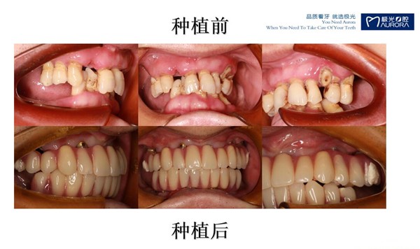成都極光口腔避免做全口種植牙后悔,來一波全口牙缺失種植案例供你參考