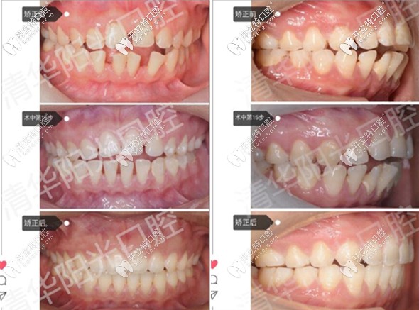 牙齒稀疏+扭轉(zhuǎn)開頜,打卡武漢清華陽(yáng)光口腔隱適美不拔牙矯正