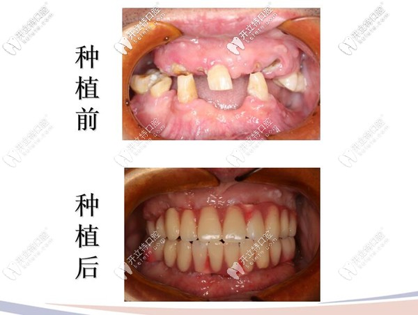牙槽骨萎縮也能做種植牙