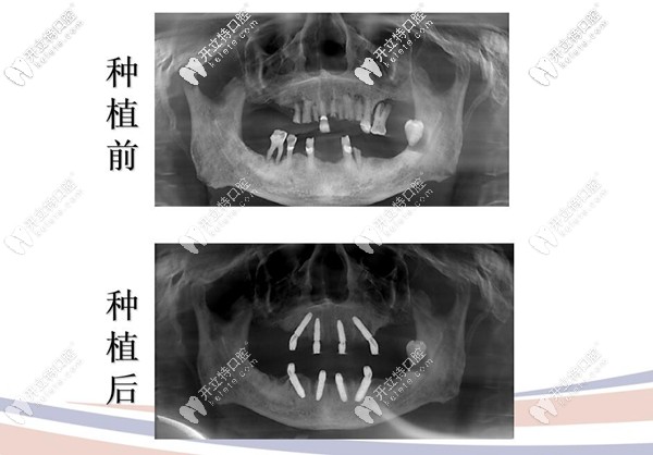 all on 4種植前后對比圖