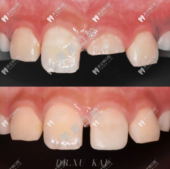 兒童乳牙斷牙修復(fù)