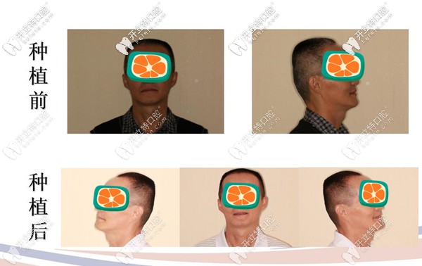 牙周炎做種植牙后效果圖