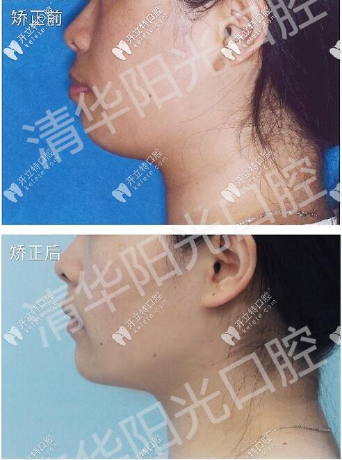 清華陽光口腔隱適美矯正案例