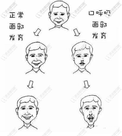 腺樣體面容和正常面容圖片