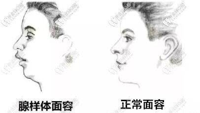 別讓這種面型毀了娃,兒童腺樣體面容戴mrc矯正器能矯正嗎？