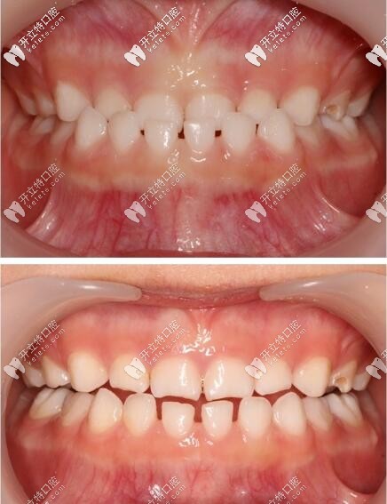 乳牙反頜蘇州寶媽竟選擇了比mrc價格貴的羅慕早期干預(yù)矯正