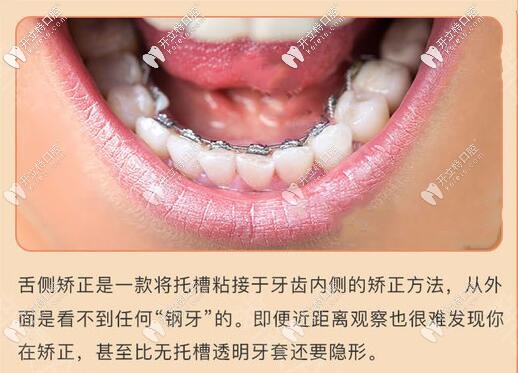 蘇州舌側(cè)隱形牙齒矯正價(jià)格