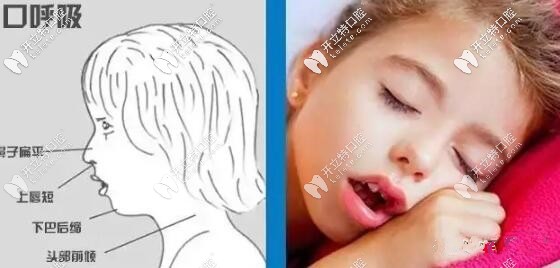 兒童口呼吸