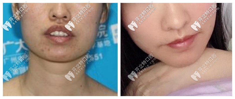 凸嘴齙牙正頜手術(shù)前后對比