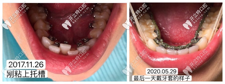關注舌側隱形矯正價格的同時,eBrace舌側矯正的效果你知道嗎