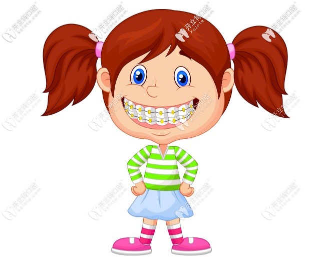 到底哪種牙套好呢 