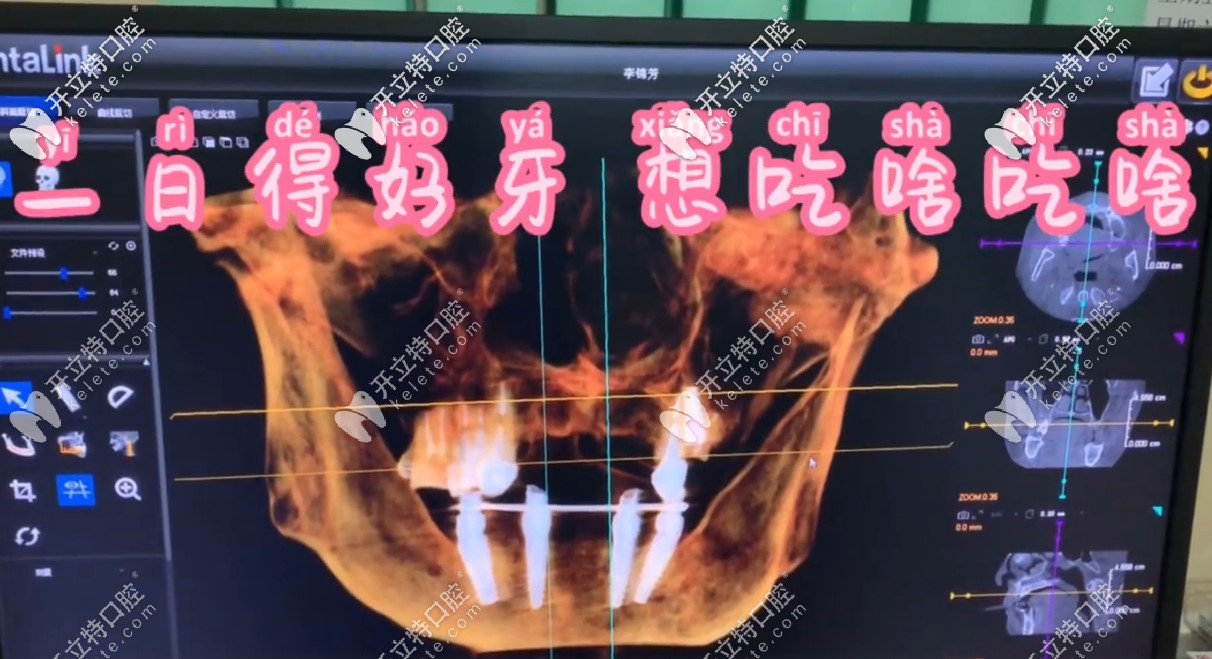 用“一日得好牙”技術種半口牙，術后即刻就能進食