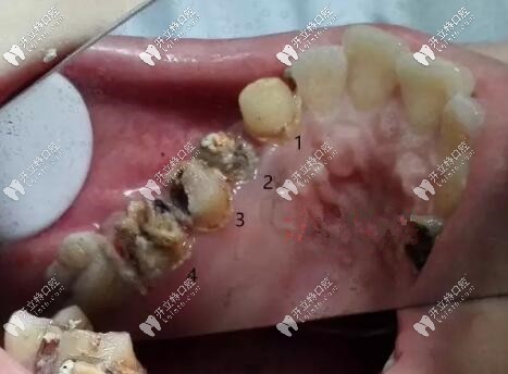 烤瓷冠拆掉后基牙圖片