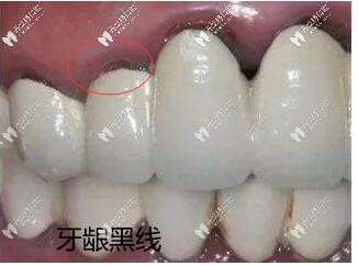 烤瓷牙基牙腐爛一摸手都是臭的,分享拆烤瓷牙的過程圖片