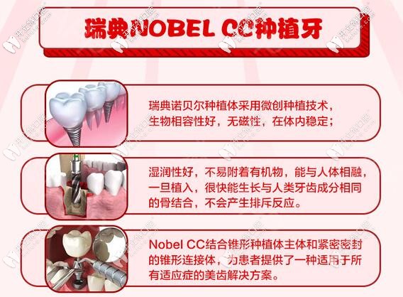 蘇州瑞典諾貝爾種植牙價格