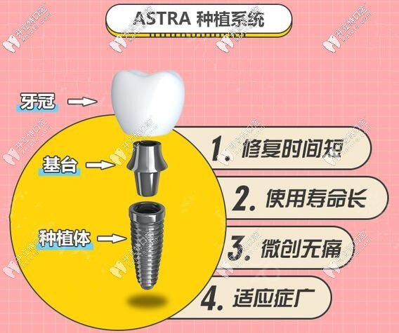 蘇州美奧口腔瑞典Astra種植體價格
