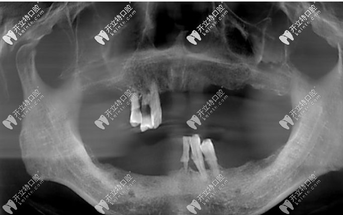 我做全口種植牙選的是astra而非諾貝爾種植體，不只因為價格