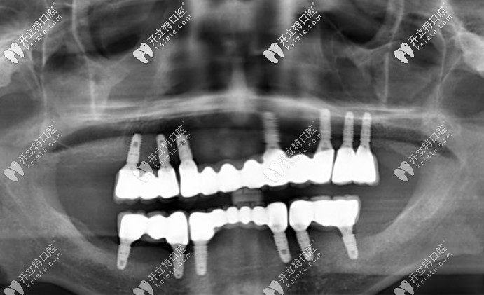 在美奧口腔做全口種植牙效果圖