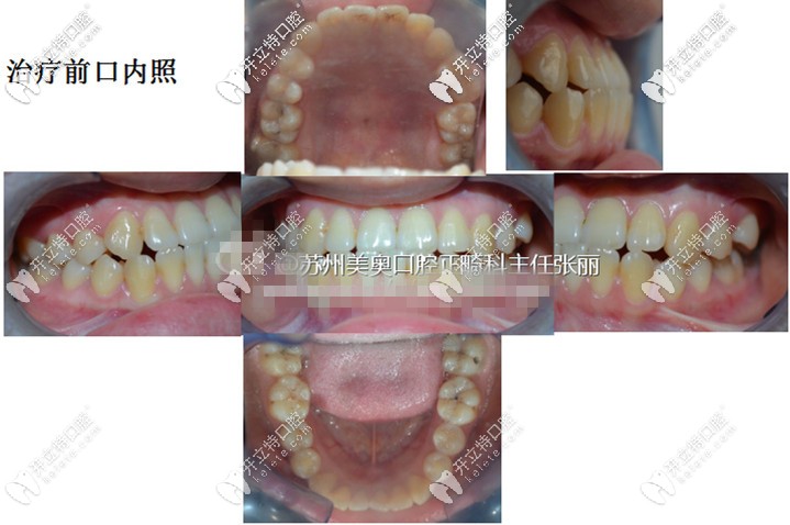 附上治療前的口內(nèi)照——上頜、左側(cè)面和右側(cè)面、下頜