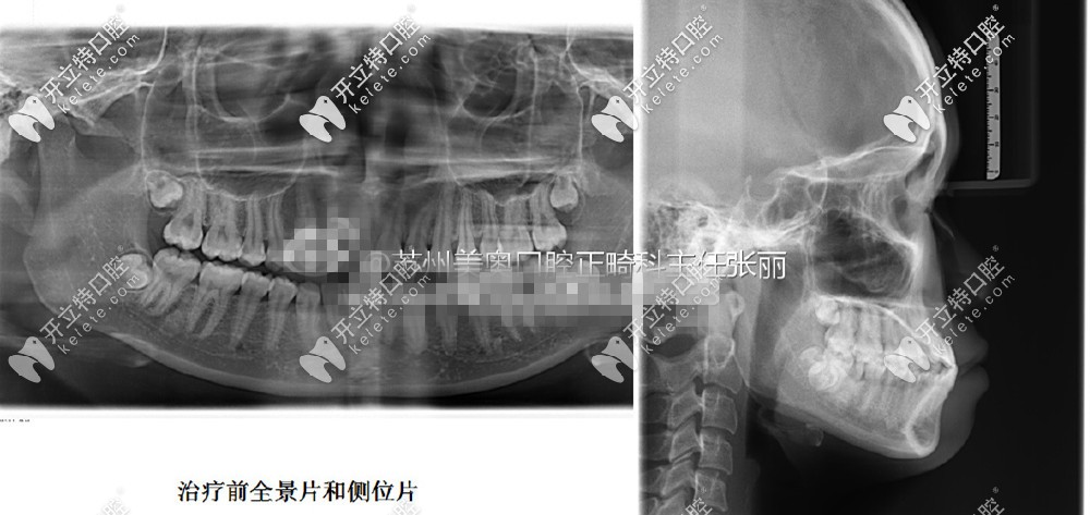 治療前的全景片和側(cè)位片