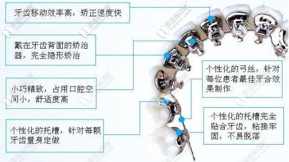 舌側矯正的優(yōu)勢