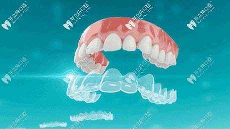 時(shí)代天使隱形牙套 時(shí)代天使隱形牙套