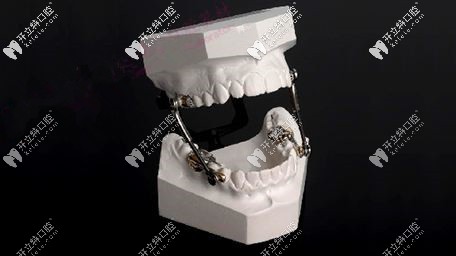 Herbst(赫氏矯治器) Herbst(赫氏矯治器)